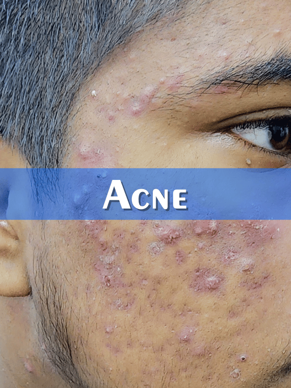 Acne Treatment